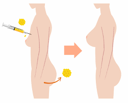 Fat Transfer Breast Augmentation